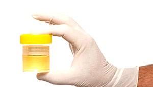 Kaj kaže temno rjav urin?