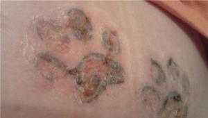 Odstranjevanje tetovaž - laser in druge metode;  odstranjevanje tetovaže doma