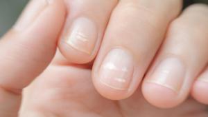 Как да излекуваме ноктите: методи за лечение и профилактика на възможно повръщане Как да излекуваме ноктите